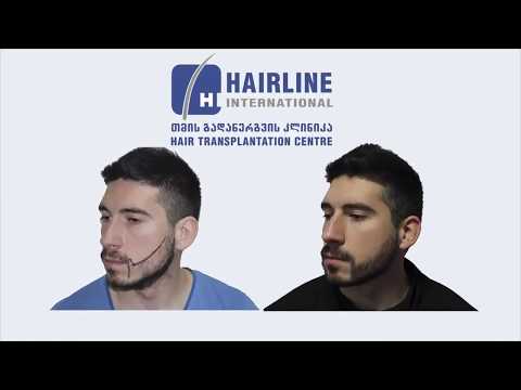 წვერის გადანერგვა არაოპერაციული FUE მეთოდით - Beard transplantation with non surgical FUE method